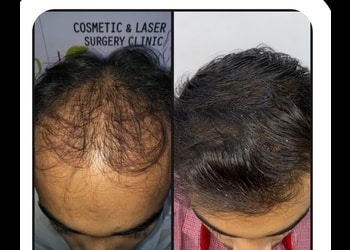 Dr-v-s-rathore-Hair-transplant-surgeons-Shyambazar-kolkata-West-bengal-1