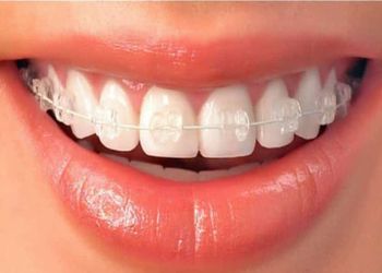 Kalpana-care32-dental-clinic-Invisalign-treatment-clinic-Warangal-Telangana-3